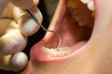 歯周病の治療(軽度)の場合